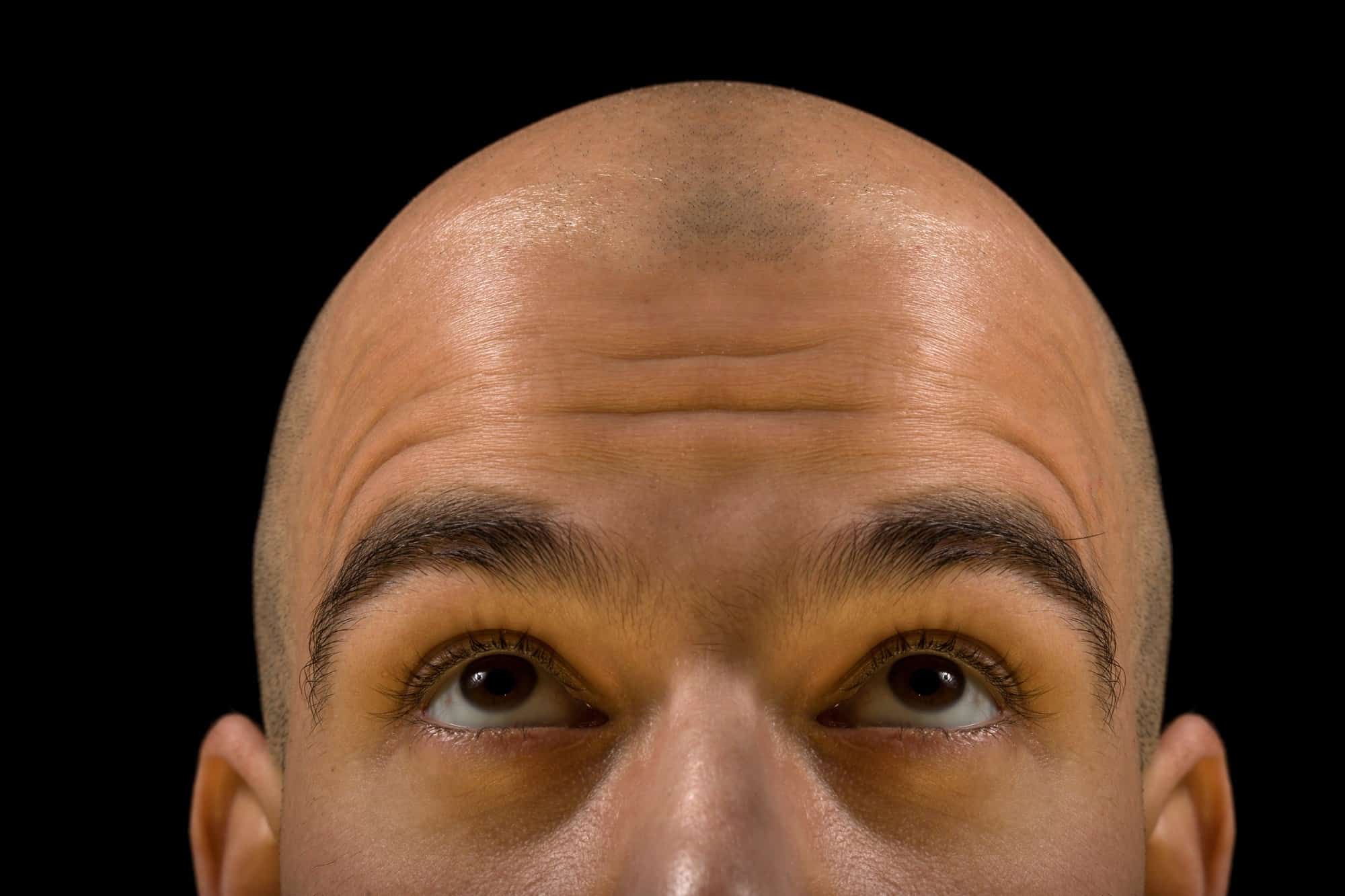 Male Pattern Baldness Treatments